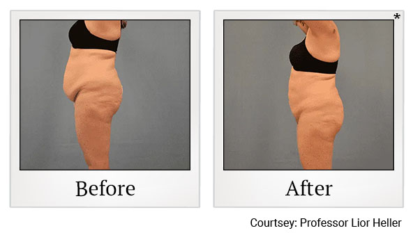 Results 7 of BeautiFill treatment at Harbor Health Center in Capitola